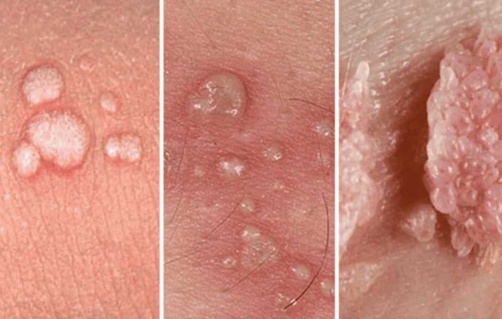 Điều trị sùi mào gà sinh dục ở nhiều vị trí khác nhau  | Vinmec