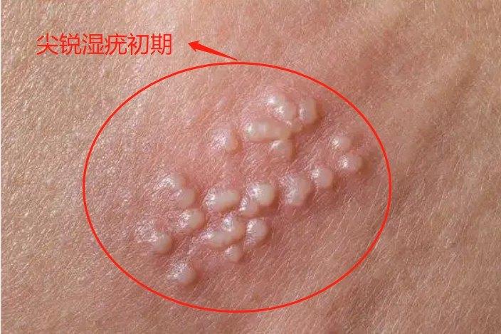 尖疣早期图片 | 百度健康·医学科普